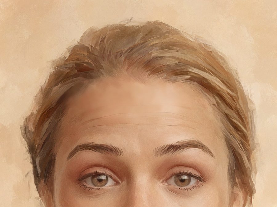Illustration après, vers J15 : rides horizontales du front adoucies, expression conservée, femme, 30-35 ans (même illustration retouchée)